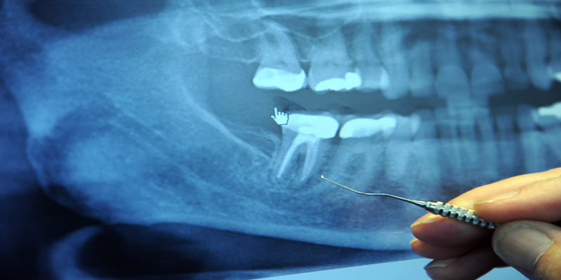 Endodontic Treatments at PERFECT SMILE